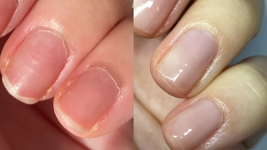 Dealing with Brittle Nail Issues Tips for Healthy and Beautiful Nail Care