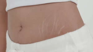 Preventing and Treating Stretch Marks Causes and Effective Solutions