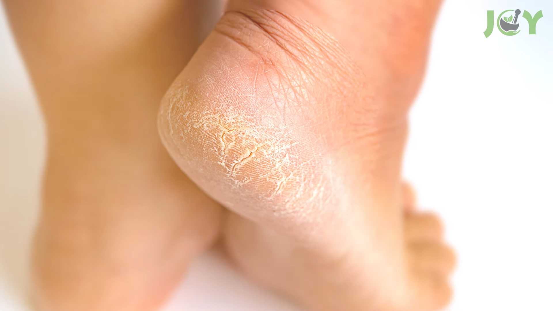 Make a DIY Foot Scrub to Treat Rough, Dry Skin