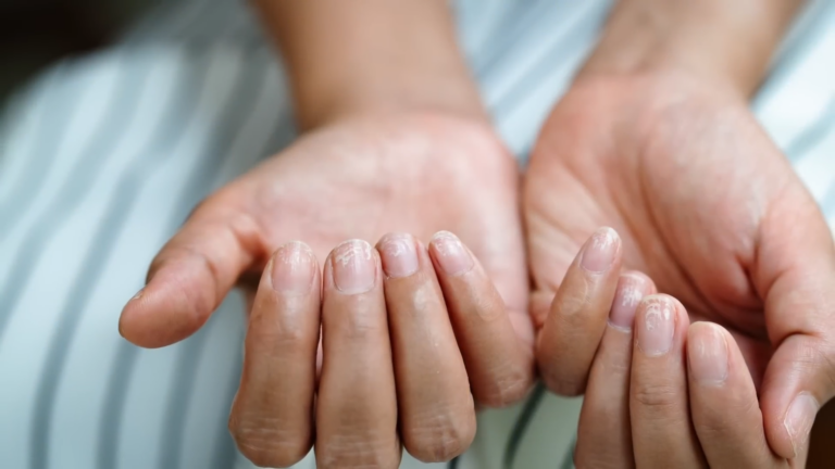 Prevent and Treat Brittle and Cracked Nails