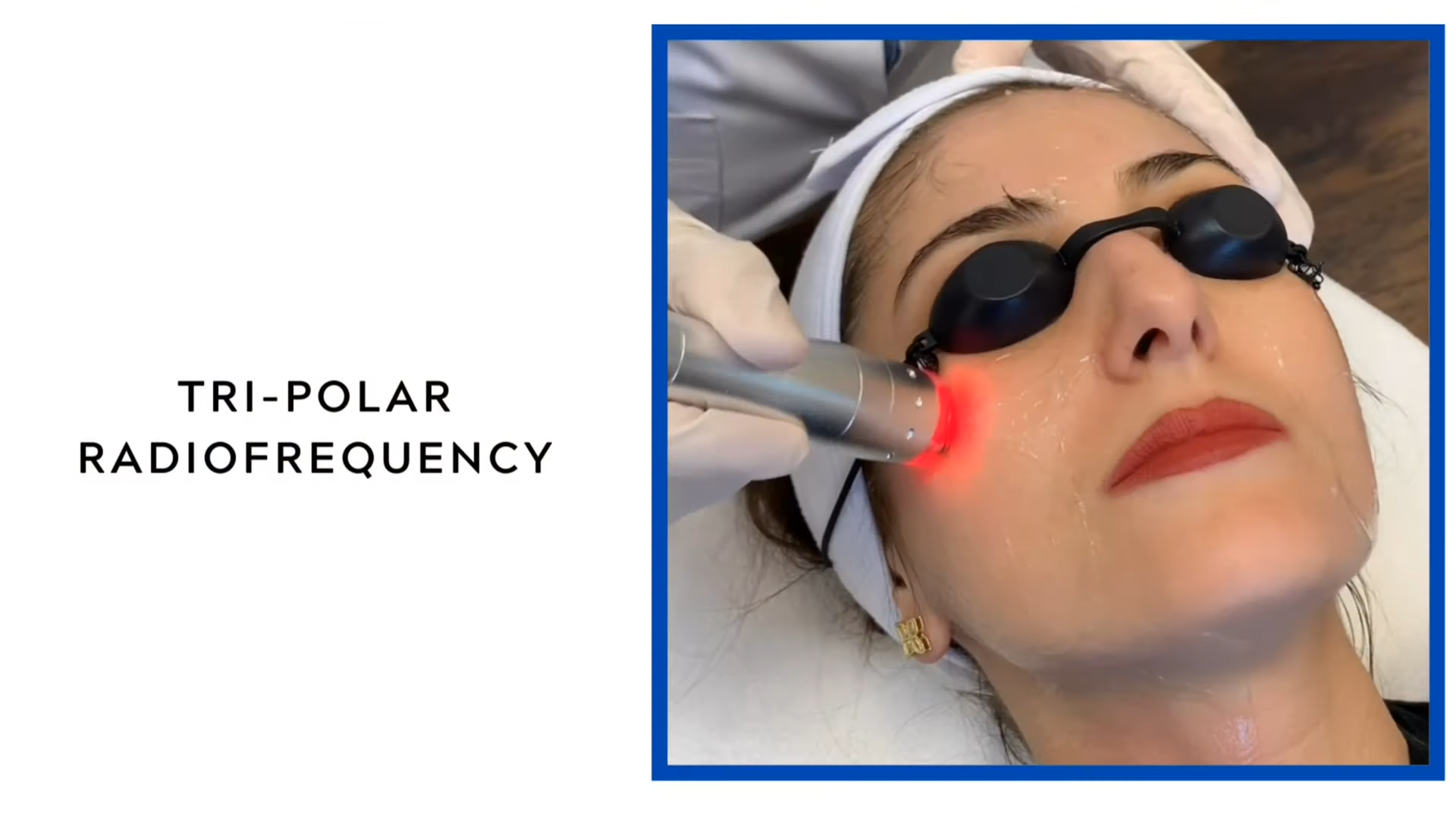 Radiofrequency Skin Care, How to Improve Skin Elasticity