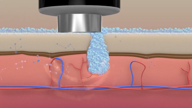 Ultrasound Technology for Skin Care